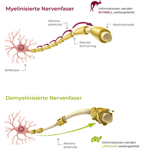 Der Unterschied zwischen myelinisierten und unmyelinisierten Nervenfasern: die Information, hier als Känguru dargestellt, kann bei intakten Nervenummantelungen schnell zwischen den „Ummantelungen“ weiterspringen. Ist die Ummantelung dagegen durch die Entzündungsprozesse der CIDP angegriffen, werden die Informationen entlang der Nervenbahnen in Schildkröten-Tempo übermittelt.